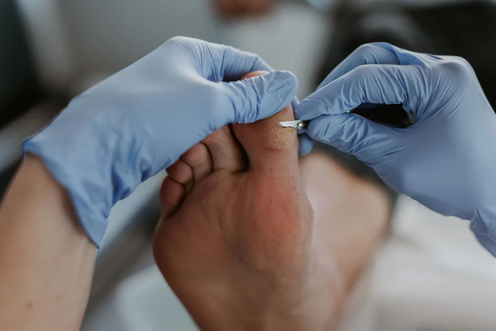 A podiatrist treating hard skin on the ball of the foot