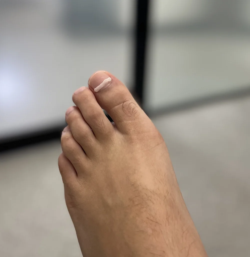 A BraceNFix nail brace applied to correct a curved toenail