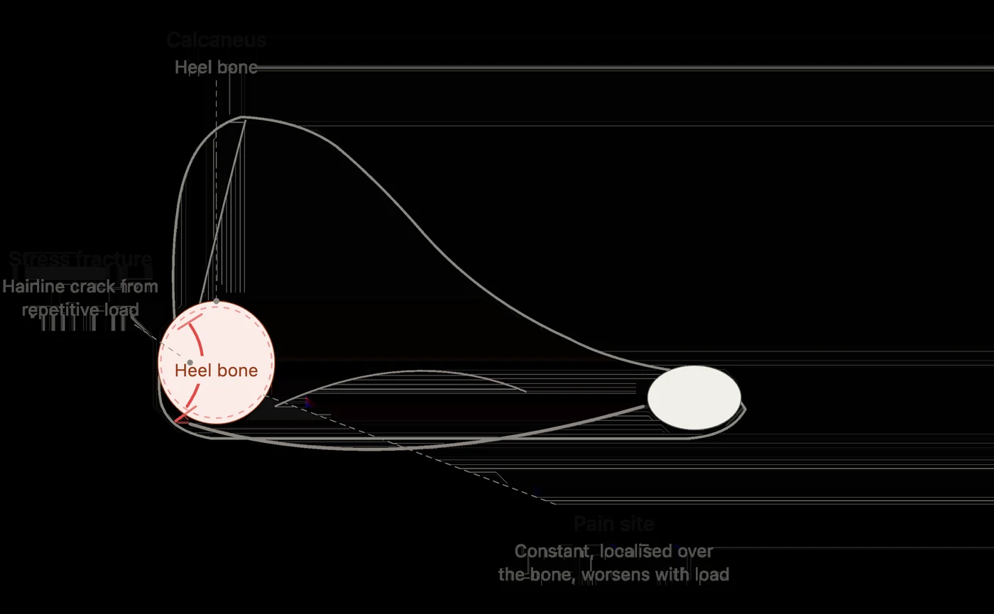 Heel anatomy diagram showing a calcaneal stress fracture